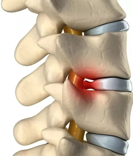 腰椎间盘突出症（常见的腰椎疾患）