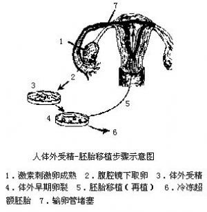 体外受精