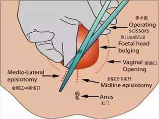 外阴切开术