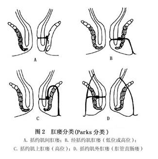 什么是单纯性肛瘘