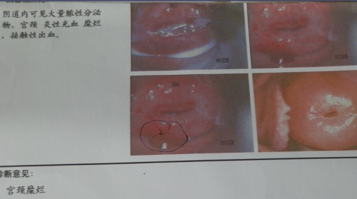 接触性出血的区别