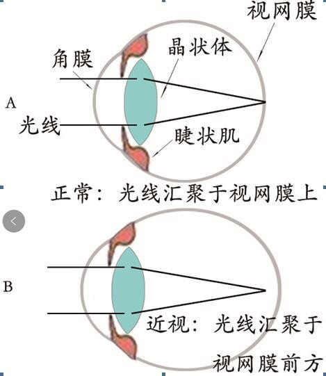 近视加散光如何治疗？