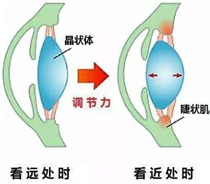 近视加散光如何治疗？