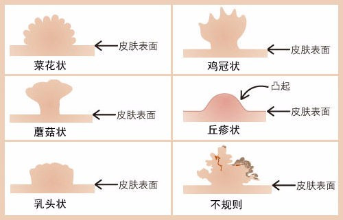 尖锐湿疣复发后有哪些症状表现