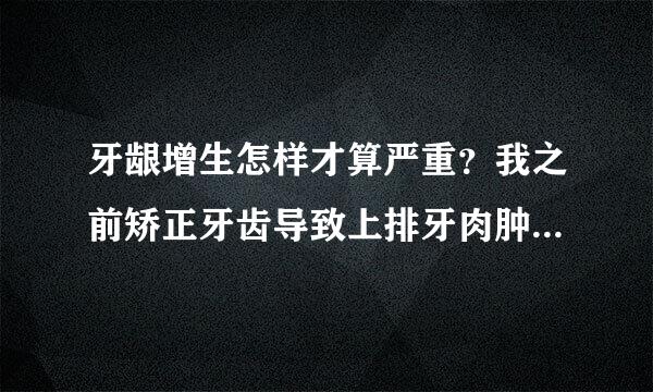 牙龈增生怎样才算严重？我之前矫正牙齿导致上排牙肉肿胀（其实牙肉本来就有点肿胀）听别人说要切