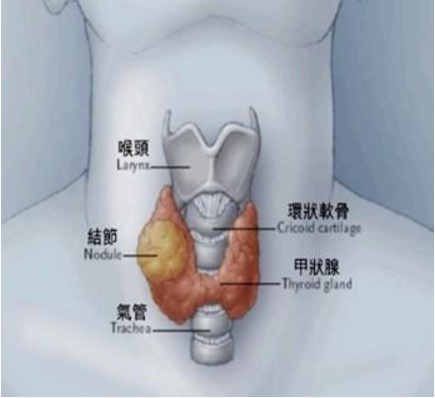 甲状腺结节能治愈吗？