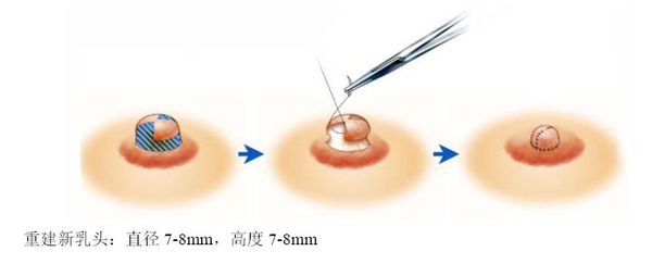 女性乳头为什么会变大|女性乳头变大的原因