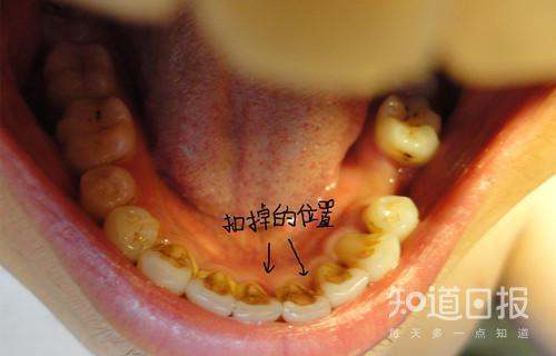 牙齿内侧黄临自黄的牙垢怎么清除