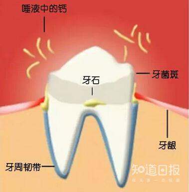 牙齿内侧黄临自黄的牙垢怎么清除