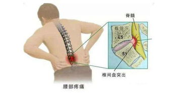 腰肌劳损跟腰椎间盘突出有什么区别？