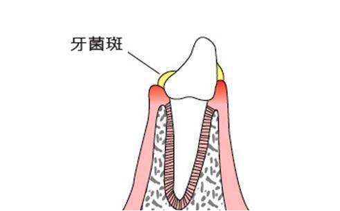 牙菌斑是什来自么？牙上的小黑点吗？