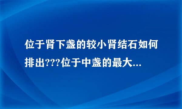 位于肾下盏的较小肾结石如何排出???位于中盏的最大肾结石已经排到膀胱里来自了。