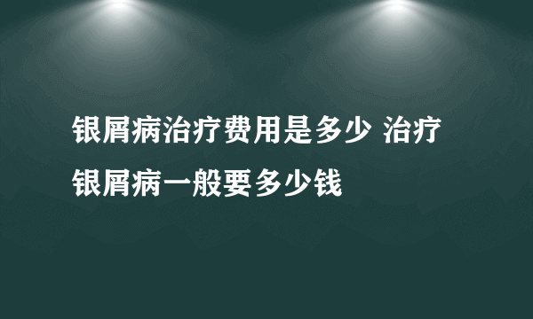 银屑病治疗费用是多少 治疗银屑病一般要多少钱