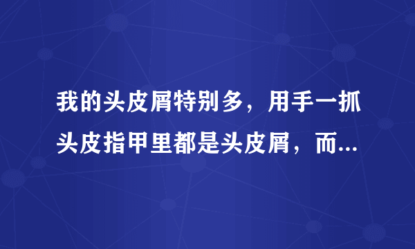 我的头皮屑特别多，用手一抓头皮指甲里都是头皮屑，而...